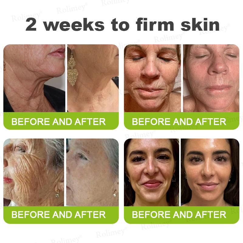 👨‍⚕️✅ Made and shipped from the USA – Rolimey® Botox & Vita-A Retinol Shot tightening and wrinkle-reducing cream – Last day of promotion, 70% OFF