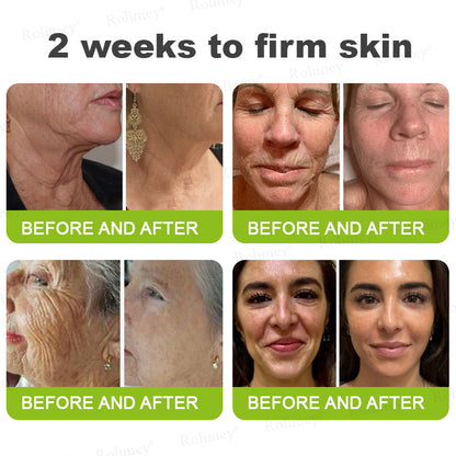 👨‍⚕️✅ Made and shipped from the USA – Rolimey® Botox & Vita-A Retinol Shot tightening and wrinkle-reducing cream – Last day of promotion, 70% OFF