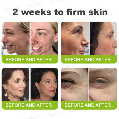 👨‍⚕️✅ Made and shipped from the USA – Rolimey® Botox & Vita-A Retinol Shot tightening and wrinkle-reducing cream – Last day of promotion, 70% OFF