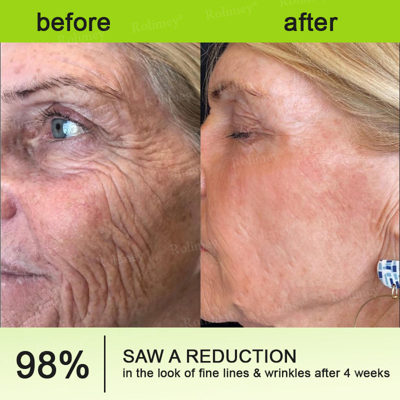 👨‍⚕️✅ Made and shipped from the USA – Rolimey® Botox & Vita-A Retinol Shot tightening and wrinkle-reducing cream – Last day of promotion, 70% OFF