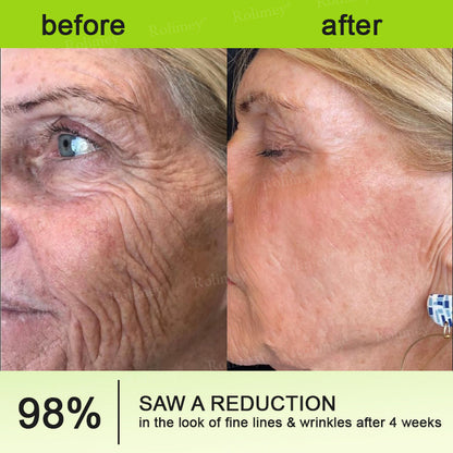 👨‍⚕️✅ Made and shipped from the USA – Rolimey® Botox & Vita-A Retinol Shot tightening and wrinkle-reducing cream – Last day of promotion, 70% OFF