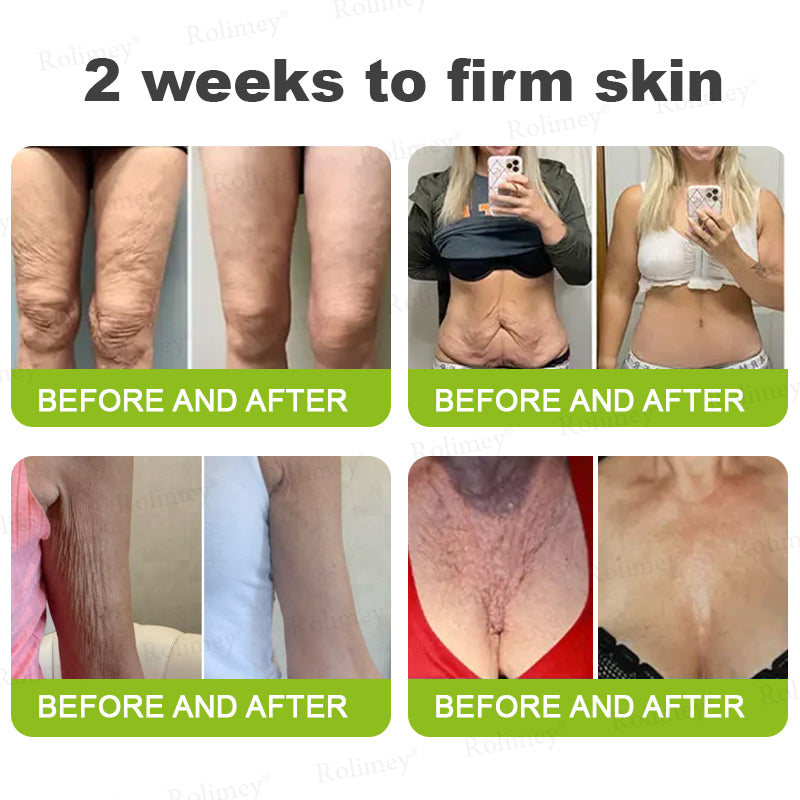 👨‍⚕️✅ Made and shipped from the USA – Rolimey® Botox & Vita-A Retinol Shot tightening and wrinkle-reducing cream – Last day of promotion, 70% OFF