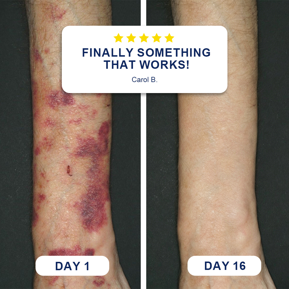 ✨Evolvion® Bruise Repair & Skin-Strengthening Cream❤️❤️❤️ (up)