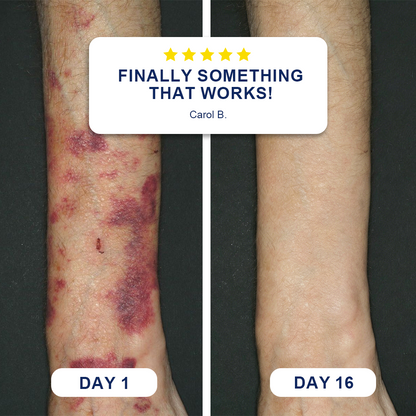 ✨Evolvion® Bruise Repair & Skin-Strengthening Cream❤️❤️❤️ (up)