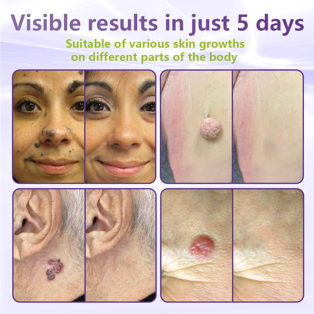 GFOUK® Soluble Microneedle Botanical Skin Tag Removal Patch