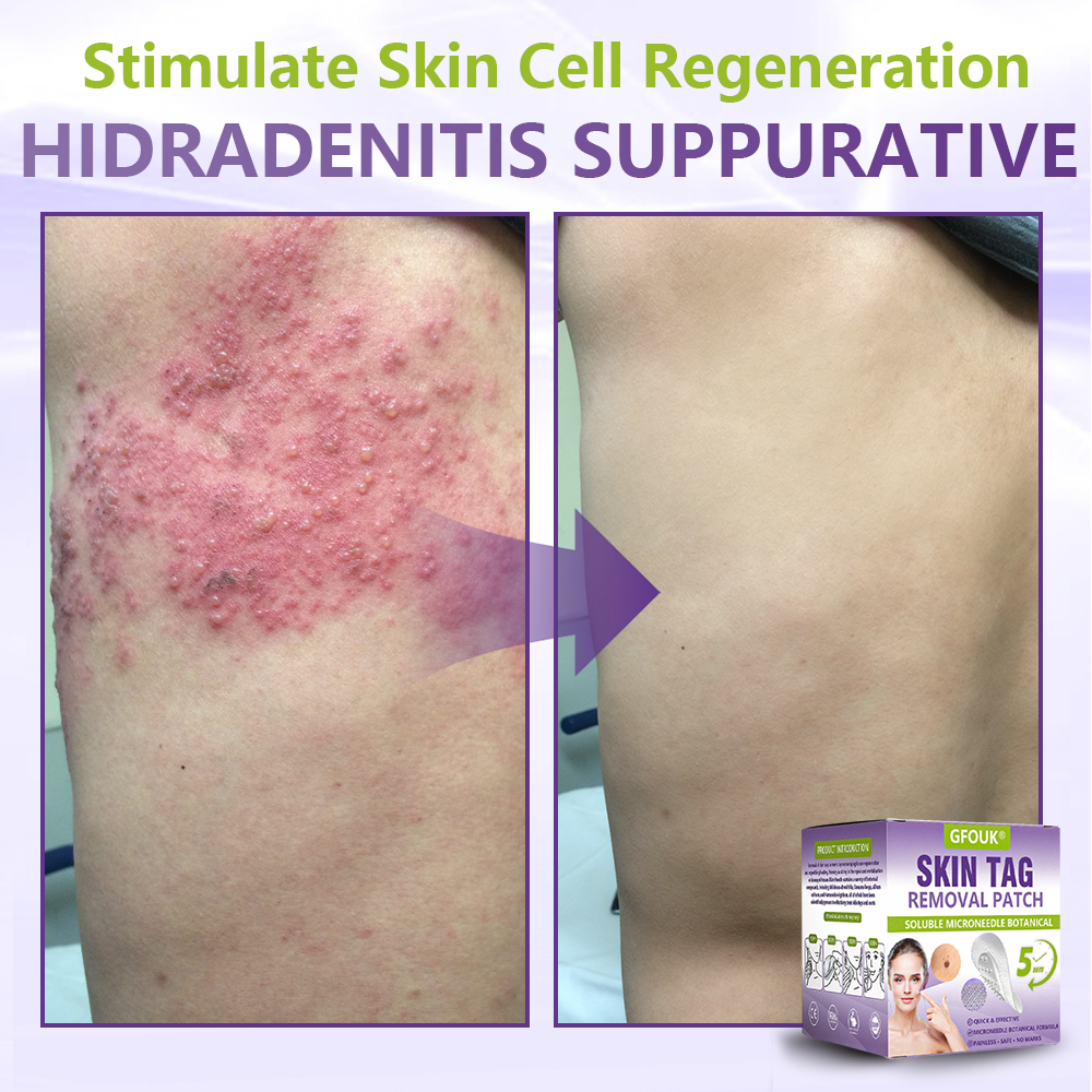 GFOUK® Soluble Microneedle Botanical Skin Tag Removal Patch